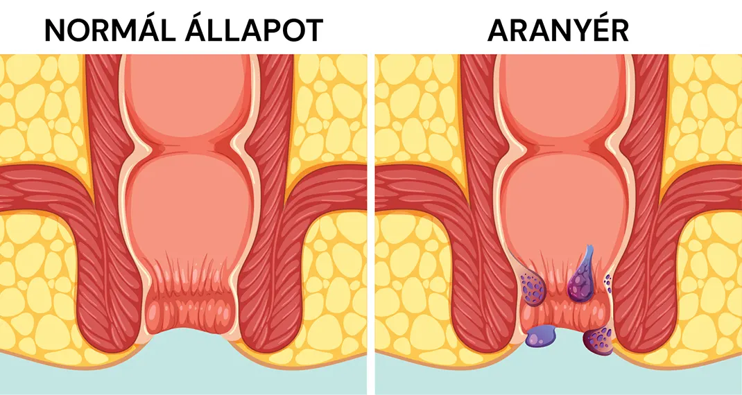 Az aranyér kezelése - normál végbél és aranyér