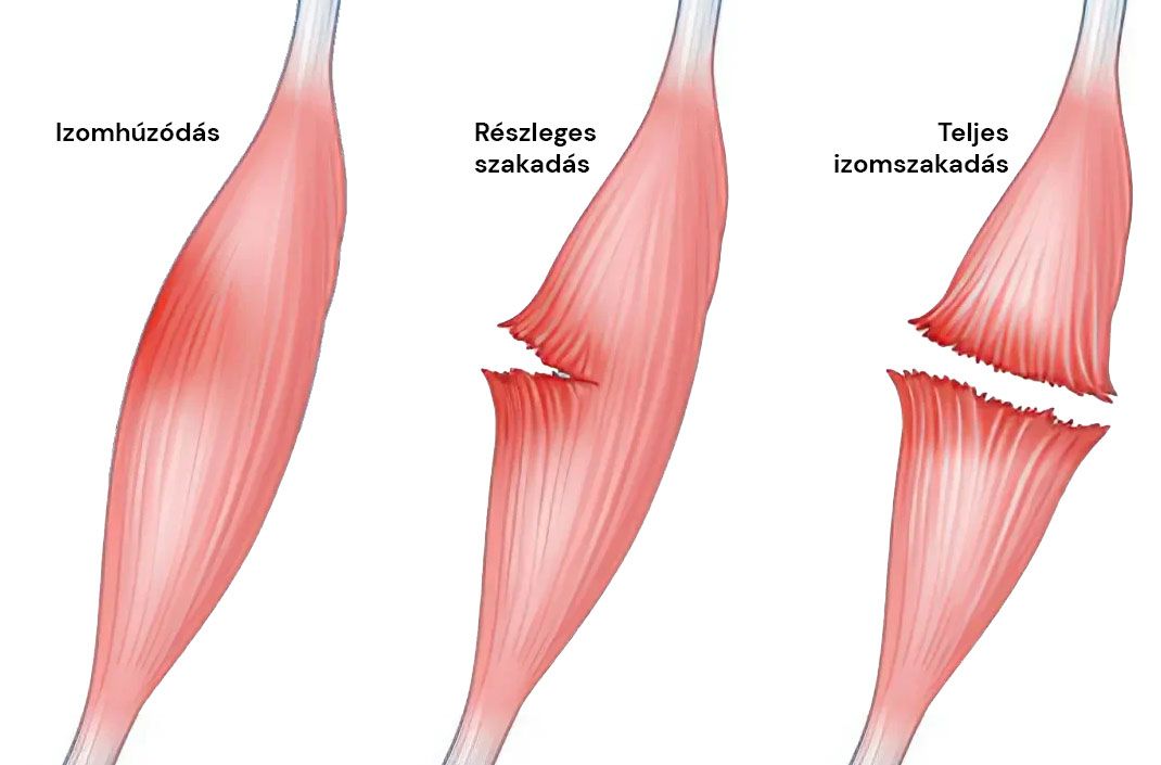 Izomhúzódás, izom részleges vagy teljes szakadása